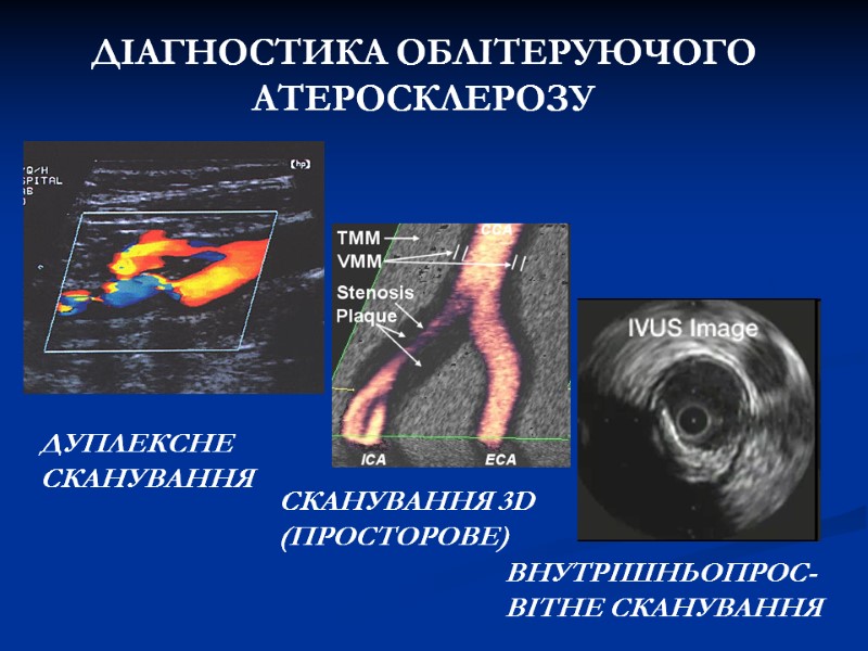 ДІАГНОСТИКА ОБЛІТЕРУЮЧОГО АТЕРОСКЛЕРОЗУ ДУПЛЕКСНЕ СКАНУВАННЯ СКАНУВАННЯ 3D (ПРОСТОРОВЕ) ВНУТРІШНЬОПРОС-ВІТНЕ СКАНУВАННЯ ДІАГНОСТИКА ОБЛІТЕРУЮЧОГО АТЕРОСКЛЕРОЗУ ДУПЛЕКСНЕ СКАНУВАННЯ СКАНУВАННЯ 3D (ПРОСТОРОВЕ) ВНУТРІШНЬОПРОС-ВІТНЕ СКАНУВАННЯ